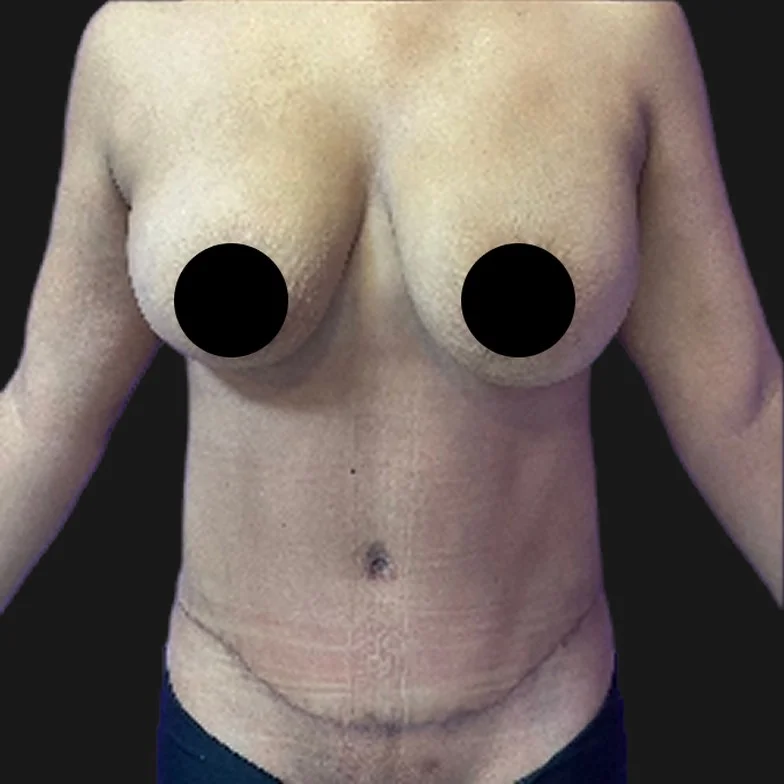 Resultado de abdominoplastia clássica — depois
