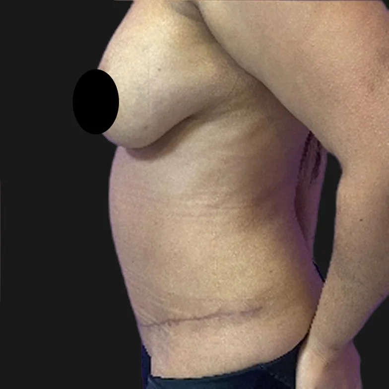 Resultado de abdominoplastia clássica — depois