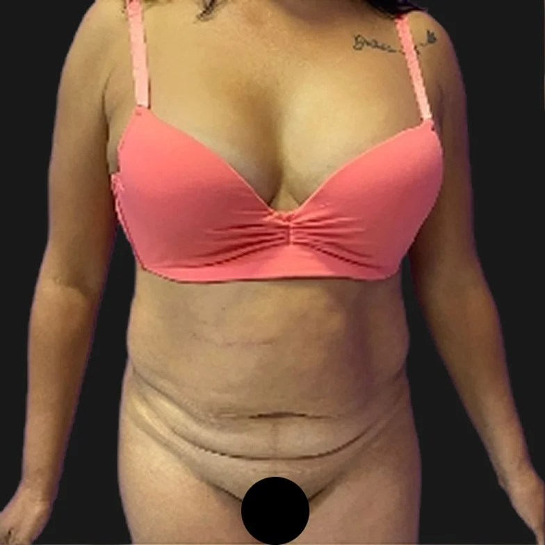 Resultado de abdominoplastia clássica — antes