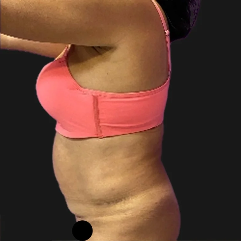 Resultado de abdominoplastia clássica — antes
