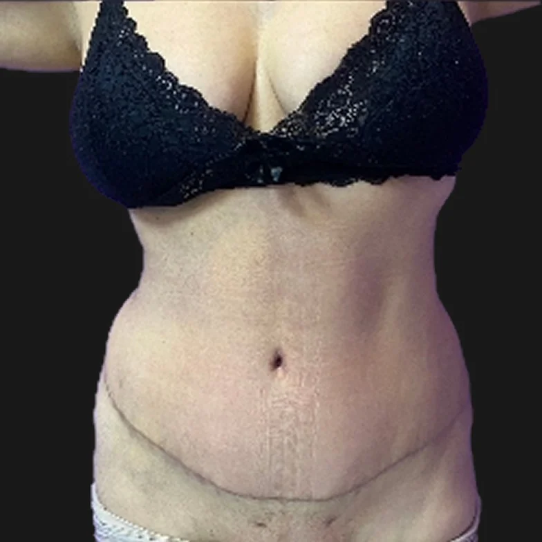 Resultado de abdominoplastia clássica — depois