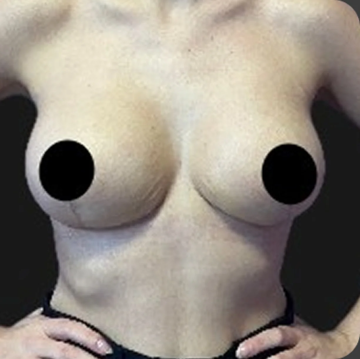 Resultado de mamoplastia redutora — depois