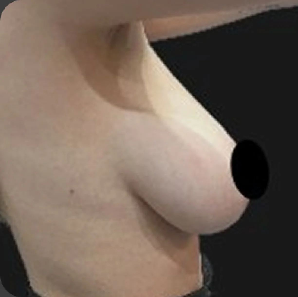 Resultado de mamoplastia redutora — antes