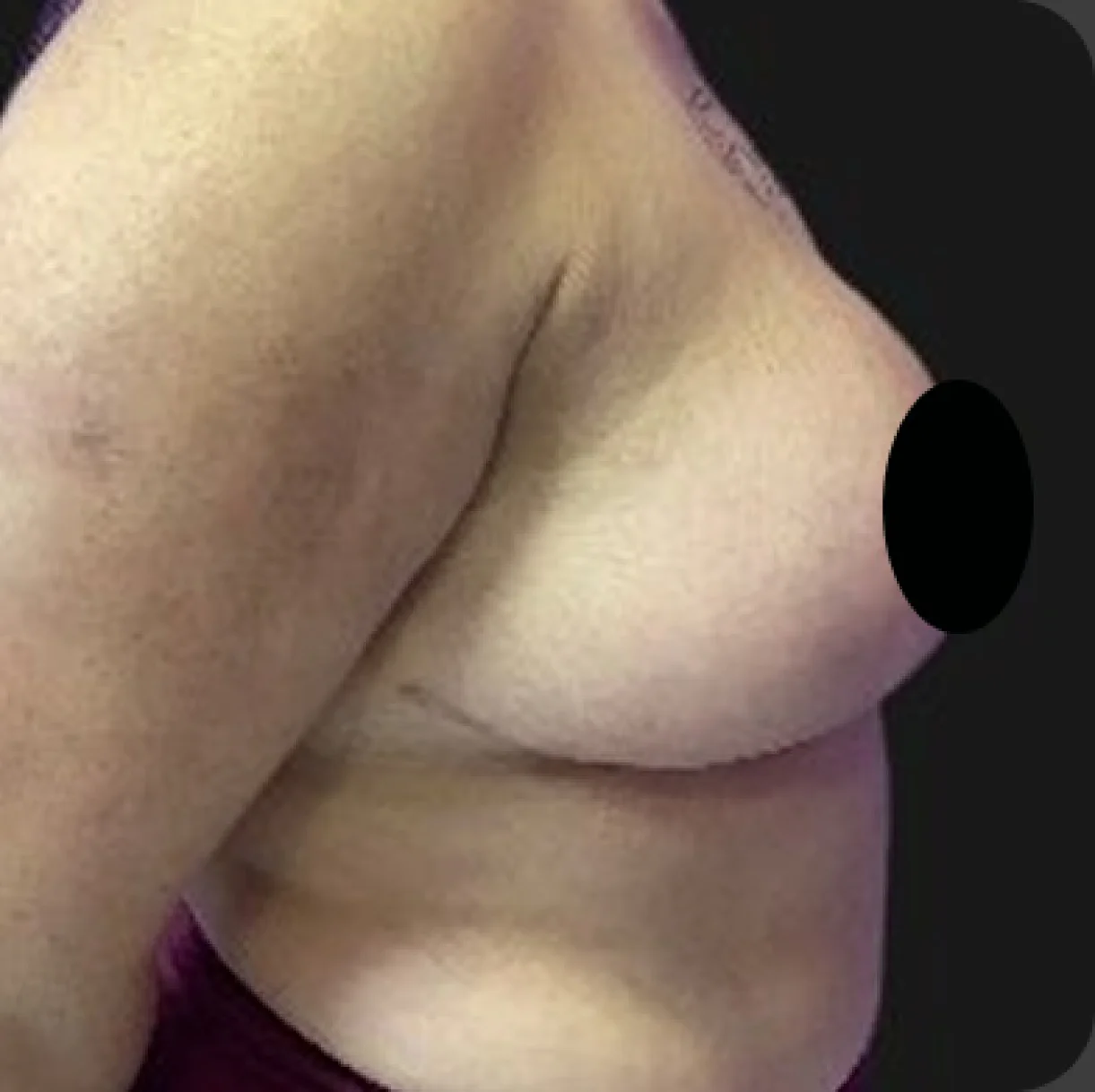 Resultado de mamoplastia redutora — depois