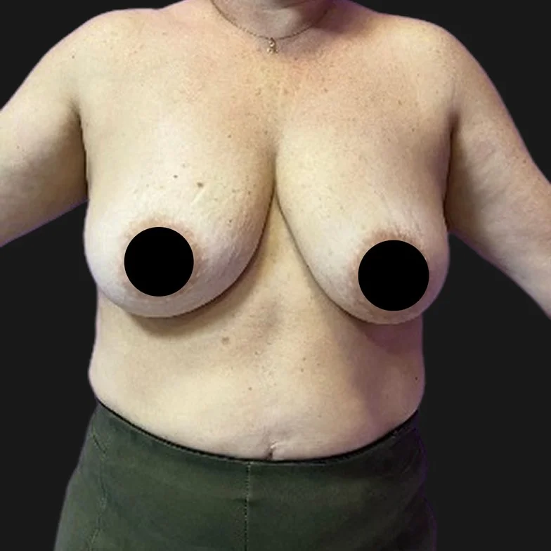 Resultado de mastopexia sem prótese — antes