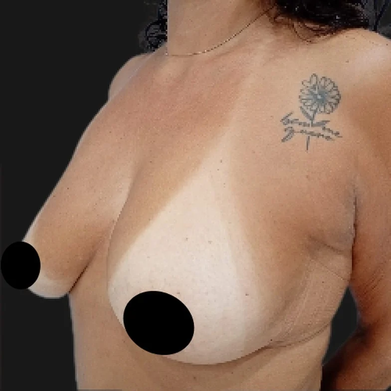 Resultado de prótese de silicone — antes