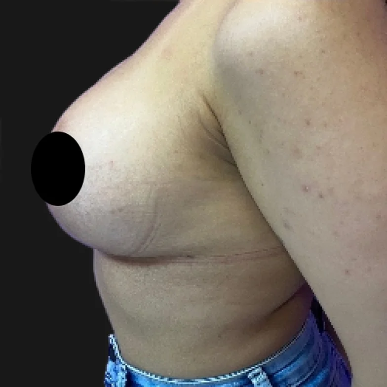 Resultado de prótese de silicone — depois