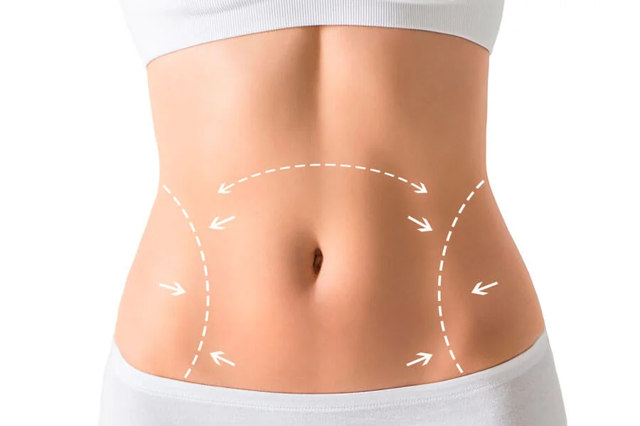 Resultado de lipoabdominoplastia