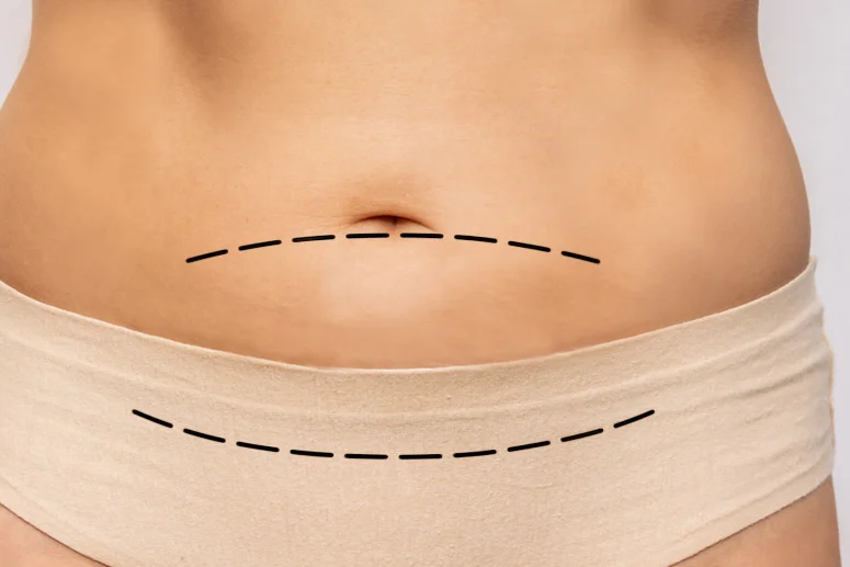 Resultado de mini-abdominoplastia